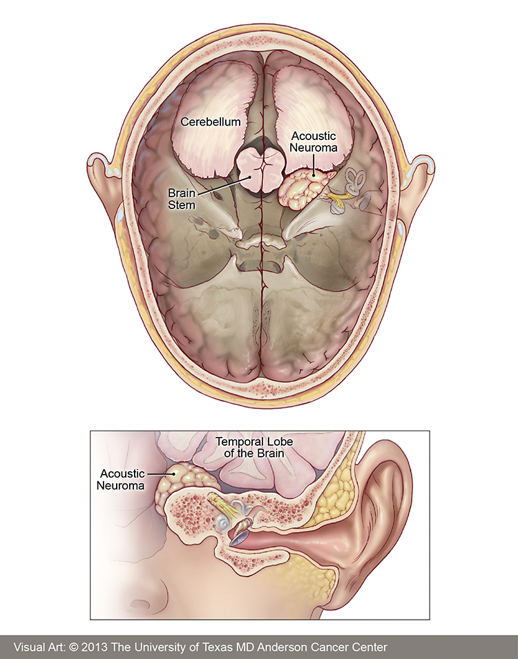Acoustic Neuroma Facts MD Anderson Cancer Center